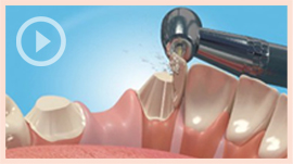 Dental Bridges