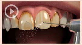 Porcelain Veneers