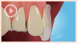 Teeth Whitening
