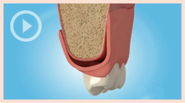 Denture Stabilisation